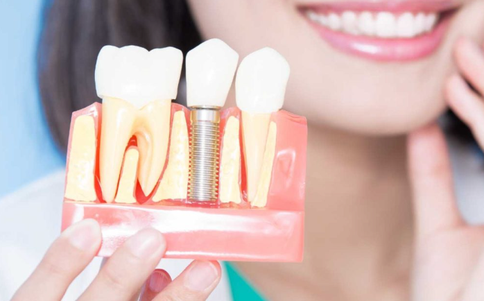 A Comprehensive Guide to Recovering After a Dental Implant Procedure